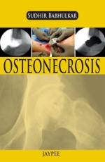 Osteonecrosis 1st Edition 