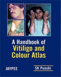 A Handbook of Vitiligo and Colour Atlas