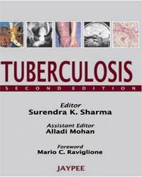 Tuberculosis