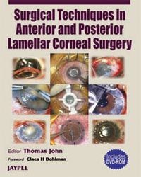 Surgical Techniques in Anterior and Posterior Lamellar Corneal Surgery (With DVD-ROM) 1st Edition 