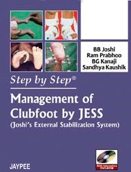 Step by Step Management of Clubfoot by Jess 
