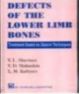 Defects Of The Lower Limb Bones