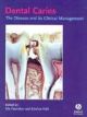 Dental Caries The Diseases And Its Clinical Management