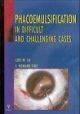 Phacoemulsification In Difficult And Challenging Cases
