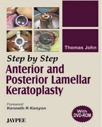 Step By Step Anterior an Post. Lamellar Keratoplasty with DVD
