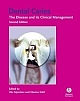 Dental Caries: The Diseases and its Clinical Management,2e